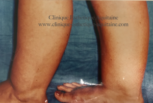 Liposuccion des jambes Bordeaux