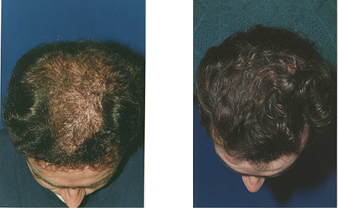 microgreffes-cheveux1