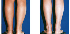 Remodelage des jambes