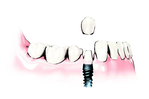 couronne-implant-dentaire