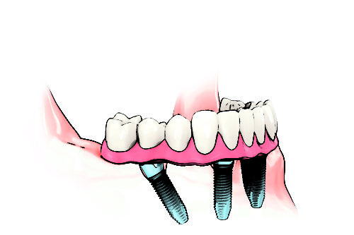 chirurgien dentiste protheses dentaires