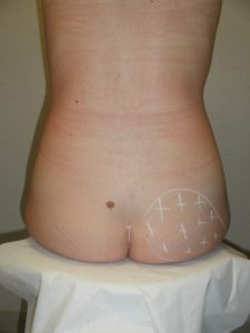 Augmentation des fesses Chirurgie Esthétique Bordeaux Clinique Esthétique Aquitaine