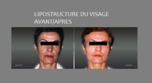 lipostructure visage femme