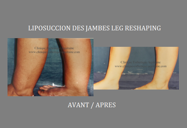 Lot De Jambes De Poupées Pour Réparation – Celluloïd/composition – Clinique – État Très Bon