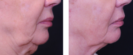 Chirurgie double menton bordeaux Chirurgie double menton bordeaux