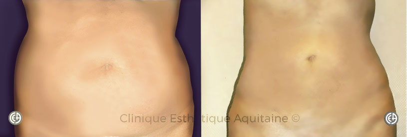 liposuccion lipoaspiration ventre