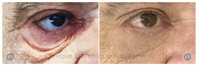 blepharoplastie homme bordeaux