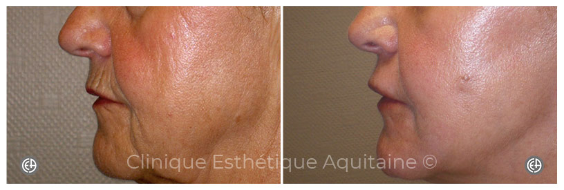 dermabrasion bouche et joue