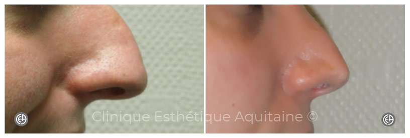 rhinoplastie femme bordeaux