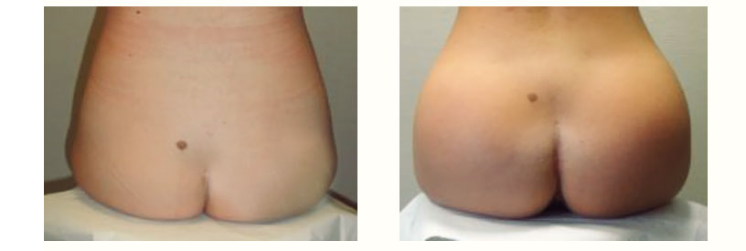 augmentation des fesses cas clinique