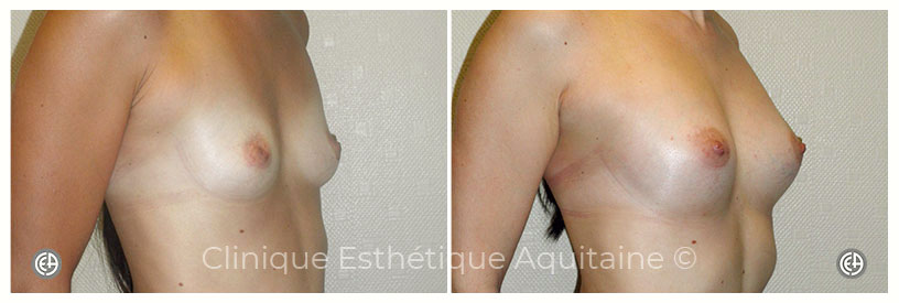 lipofilling mammaire cas clinique