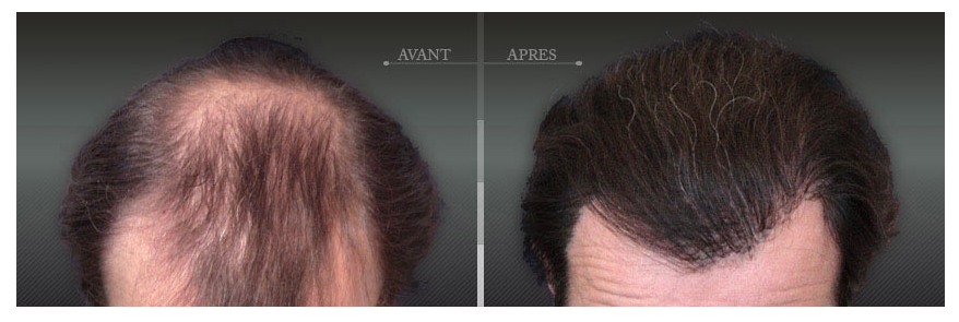 Greffe De Cheveux Fue Et Fut Clinique Esthetique Aquitaine Greffe De Cheveux Fue Et Fut Clinique Esthetique Aquitaine