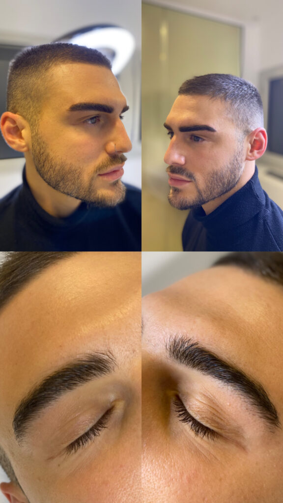 Avant Après SOURCILS MICROBLADING Thomas mialet