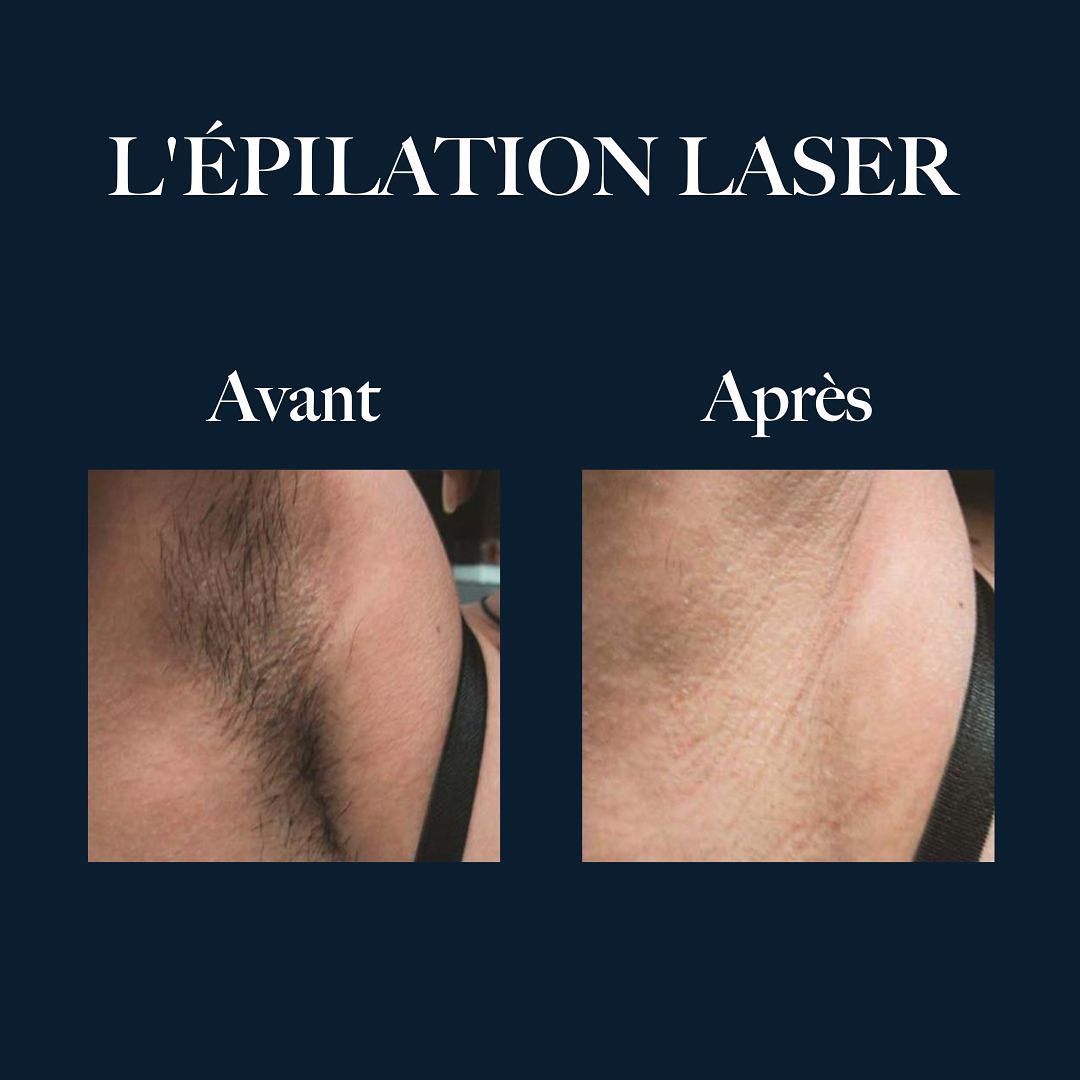 ÉPILATION LASER BORDEAUX