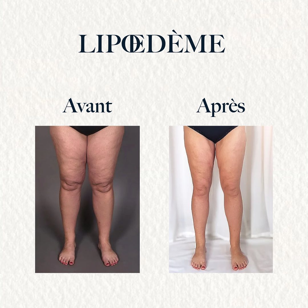 LIPŒDÈME DES JAMBES À BORDEAUX