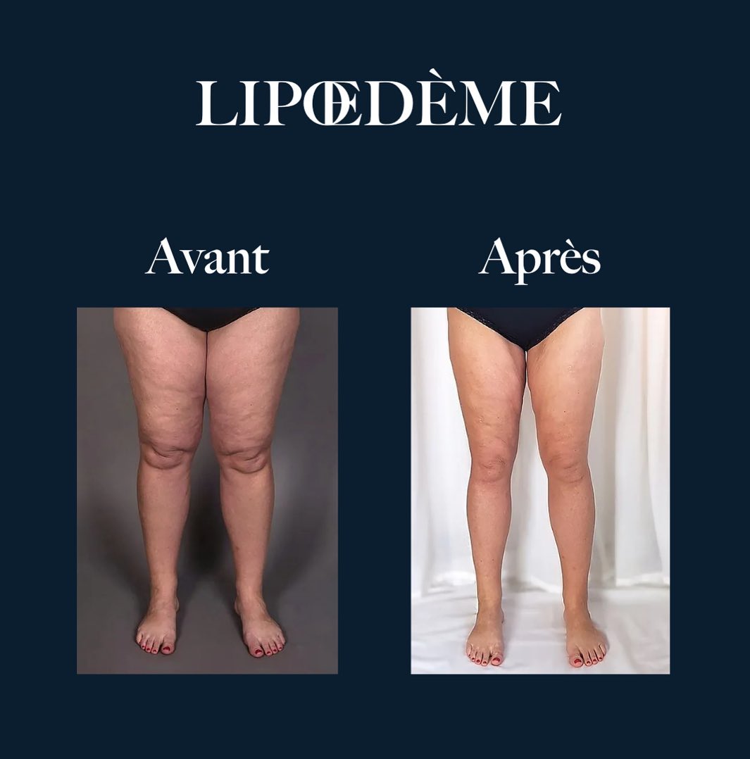 LIPŒDÈME DES JAMBES À BORDEAUX