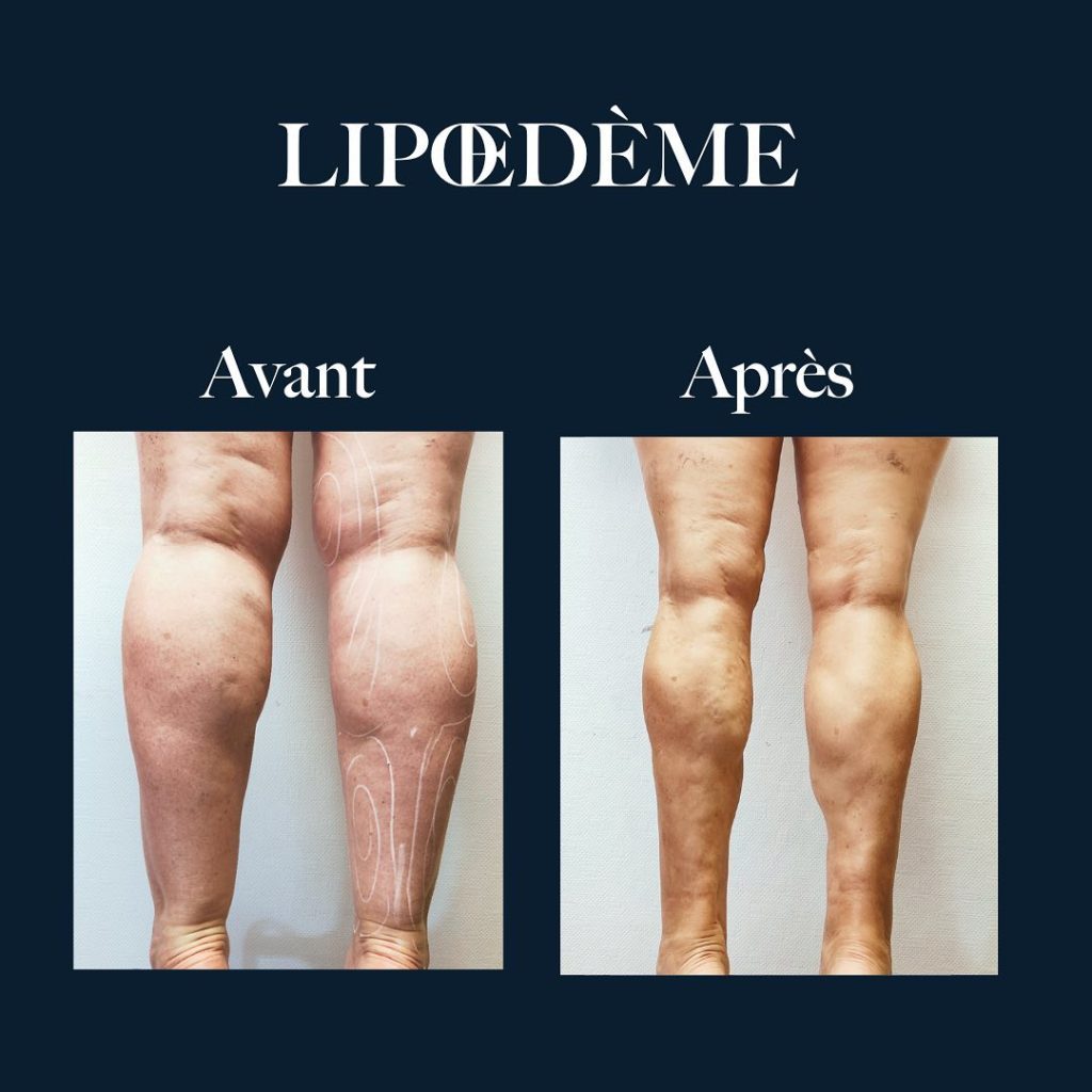 Lipoedeme jambes - Clinique Esthétique Aquitaine