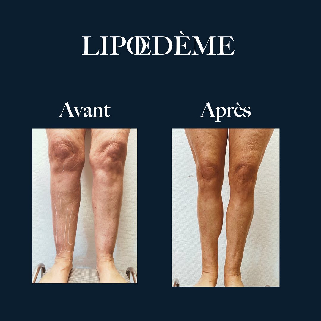 Lipoedeme jambes - Clinique Esthétique Aquitaine